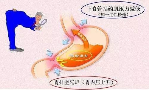 胆汁反流性胃炎|“口苦”是不是得了胆汁反流性胃炎？