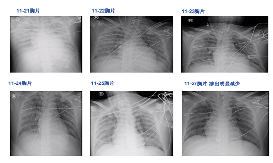 一例西维来司他钠成功救治颅脑外伤术后患者重度ards病例分享