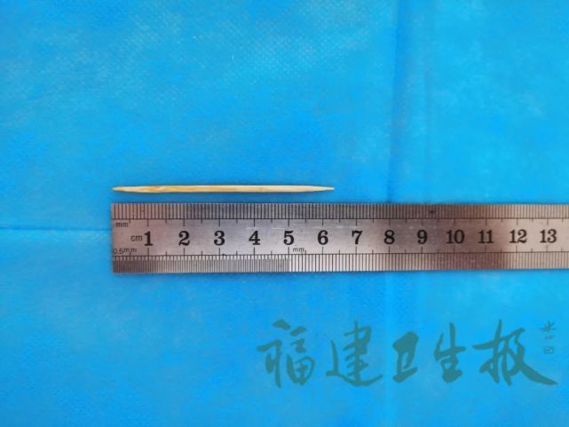惊险漳州年轻女孩耍酷玩牙签不慎误吞6天后牙签刺入肝脏