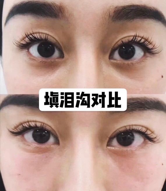 郑爽的泪沟一直很明显,加上她的黑眼圈,她看上去更加憔悴?插图14