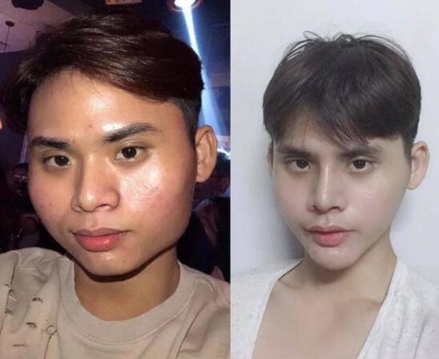 男子因长得太丑,找不到女朋友,花4万多整容后吃1个月流食变帅