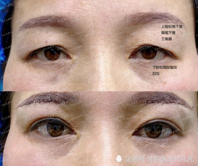 提眉术割双眼皮哪个手术难度大提眉与割双眼皮应该做哪个比较合适