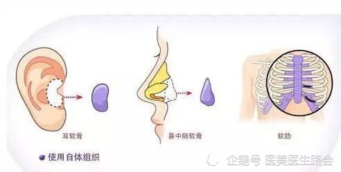 假体隆鼻|假体隆鼻比自体软骨隆鼻有哪些优势？