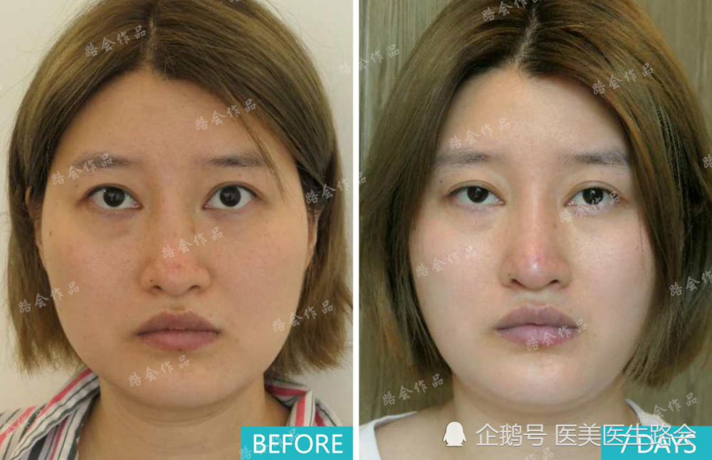 假体隆鼻|假体隆鼻比自体软骨隆鼻有哪些优势？