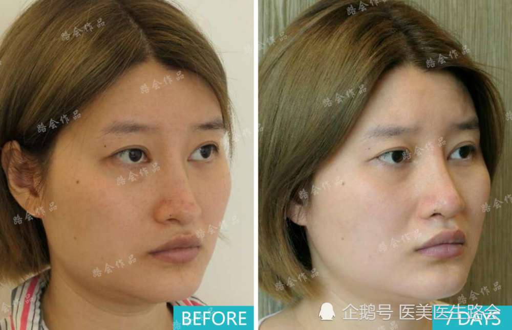 假体隆鼻|假体隆鼻比自体软骨隆鼻有哪些优势？