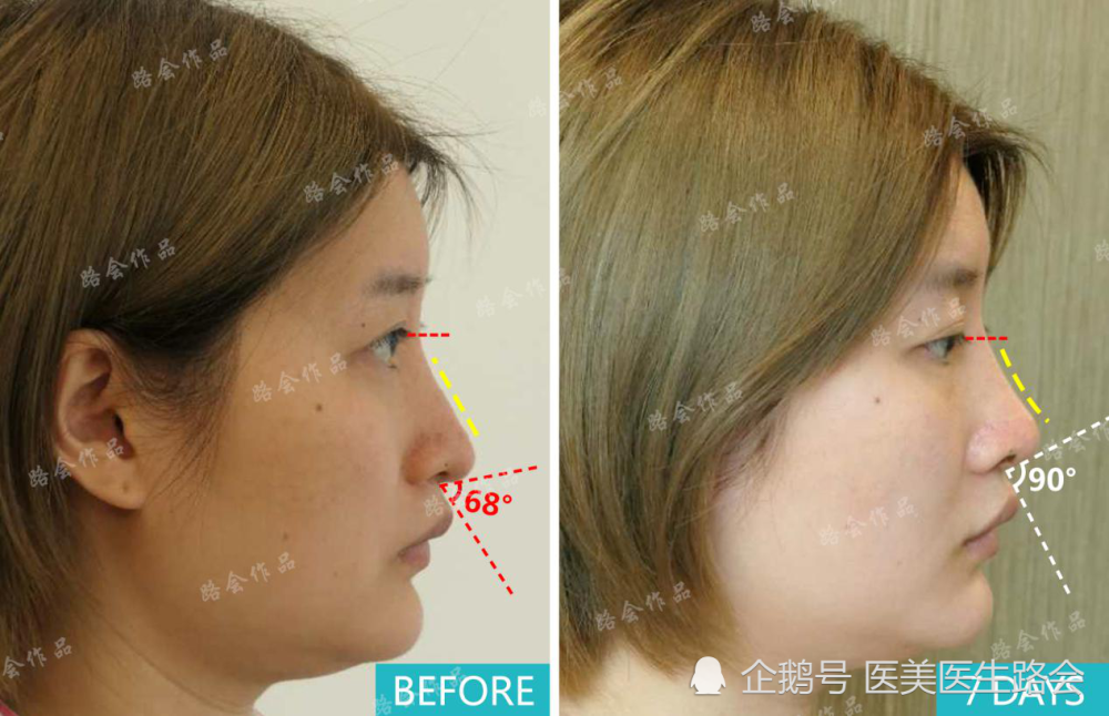 假体隆鼻|假体隆鼻比自体软骨隆鼻有哪些优势？