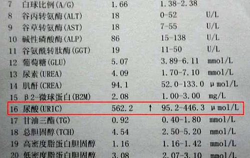 源头降尿酸王魏:关于尿酸高,你了解多少?