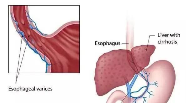 免疫功能下降肝硬化患者脾亢,免疫功能下降,加上門靜脈綜合側支循環的