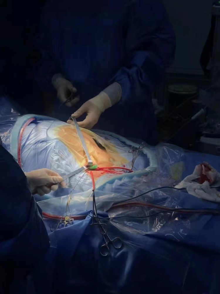 滨医附院多科室联合,成功开展首例腹主动脉球囊阻断辅助下剖宫产术