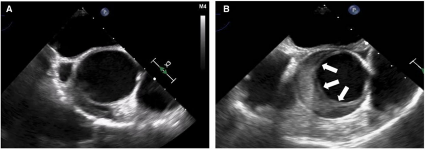 病例经食道超声心动图检查需谨慎一不小心可能出现大问题