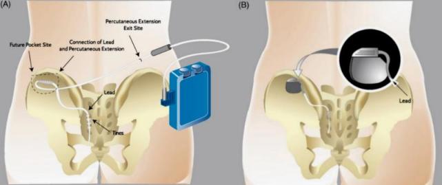 骶神经刺激器植入术 图/受访者提供黄海教授透露,此疗法通常分为两个