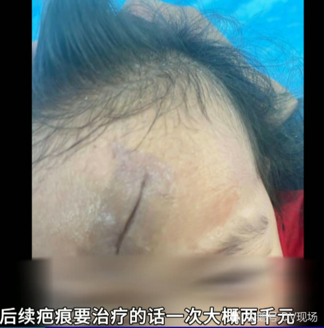 深圳:女童在波波池碰伤额头,家长却难讨赔偿