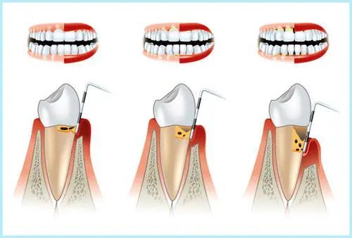 牙周炎病變過程及刮治3d動畫演示
