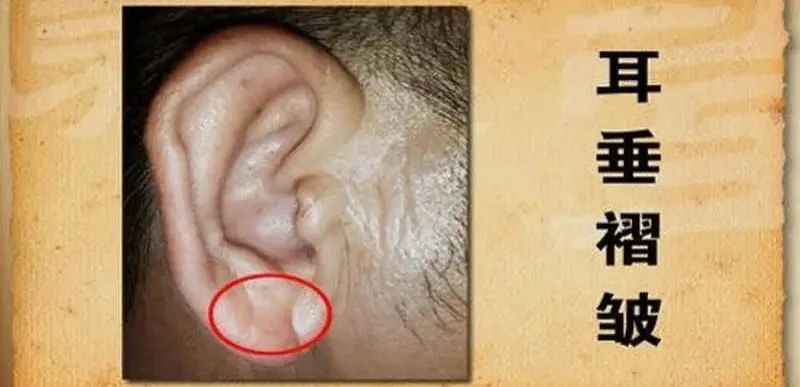 脸上突然出现这3道横纹表明你的心脏正在向你发出警报