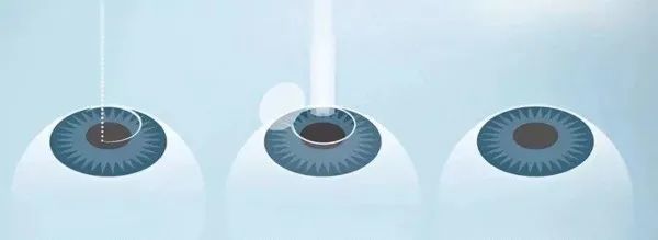 晶状体|人到中年，想摘镜该怎么办？