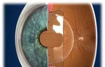 晶状体|人到中年，想摘镜该怎么办？