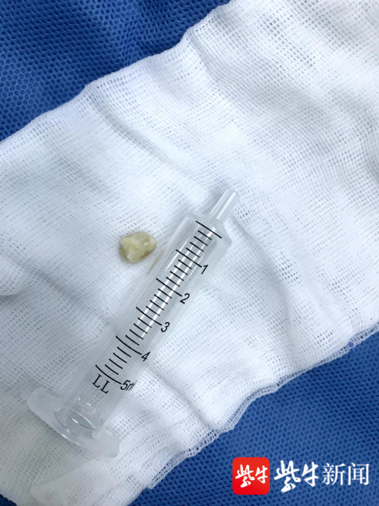 春节临近常州儿童医院连续收治多名误吞异物幼儿急诊医生发出健康提醒