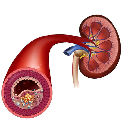 高血压患者|高血压患者怎样判断是否出现了肾损害？