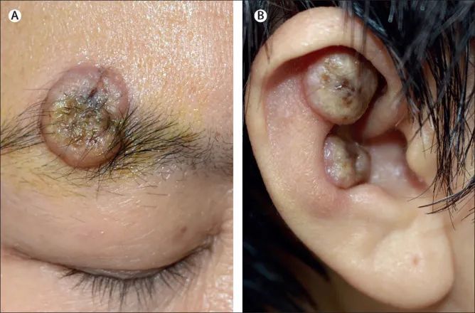 临床图片|面部皮肤多发可消退的结节,或为多发性角化棘皮瘤_腾讯新闻