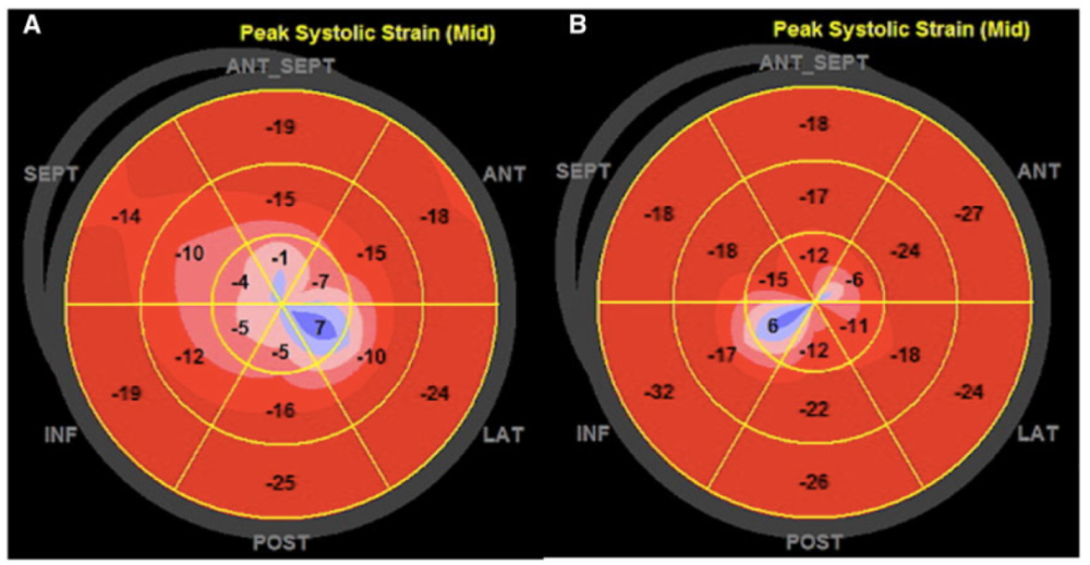 疑似自发性冠脉夹层合并takotsubo心肌病患者,该如何处理?