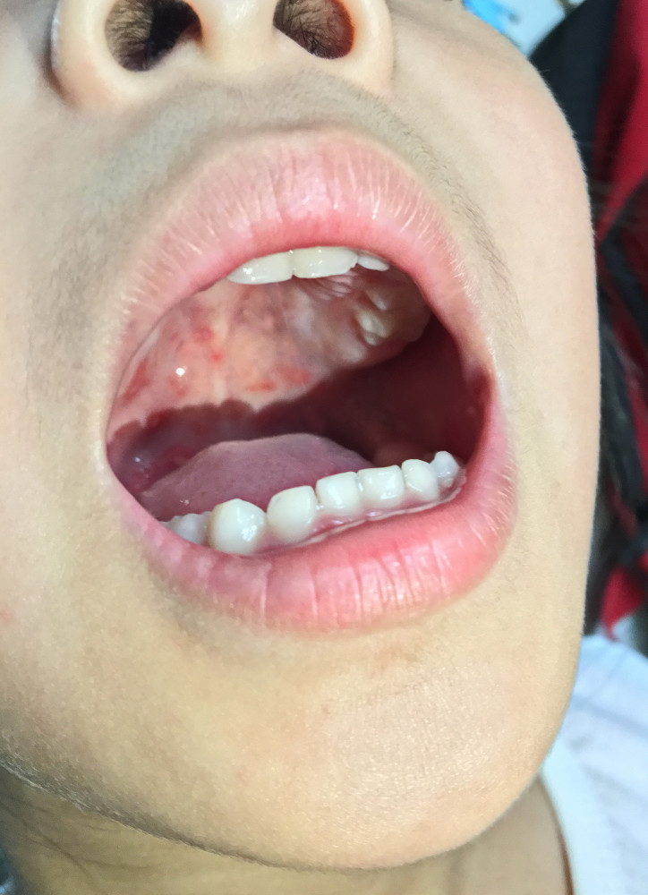 反反复复来折磨你的口腔溃疡分清是哪一种才能根治