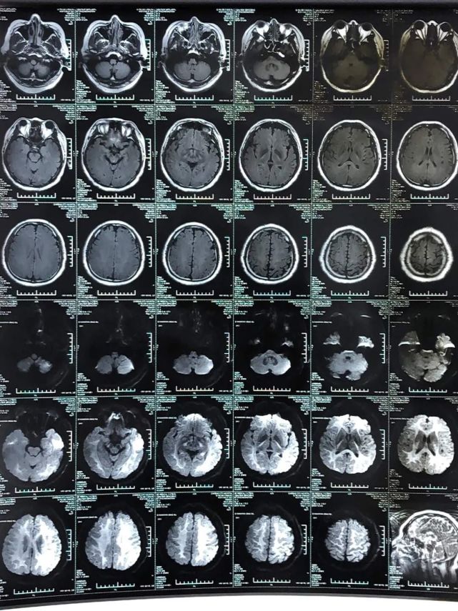 7 月 10 日複查頭顱 mri:病情好轉,患者已清醒進入高壓氧艙治療.