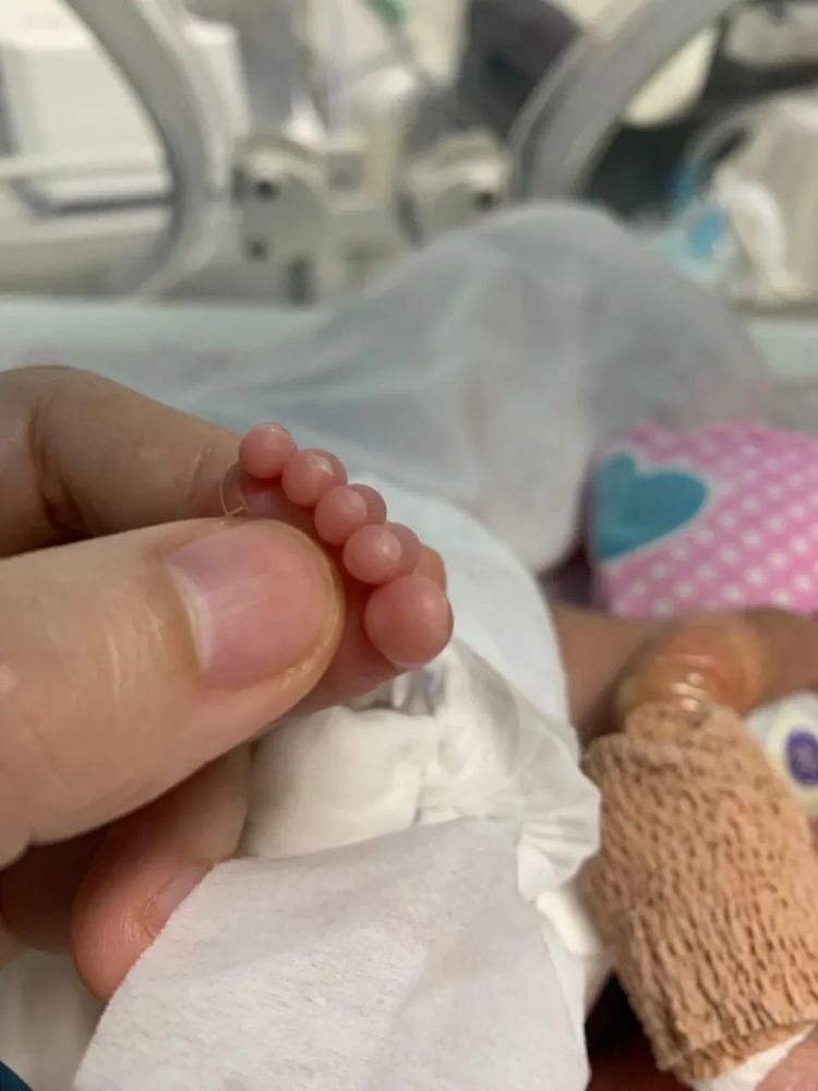 步步惊心孕27周就出生仅重1斤3两巴掌宝宝历险记