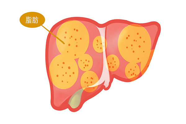 肝硬化|肝硬化早期，身体也会有“蛛丝马迹”，发现异常，赶紧查查肝脏