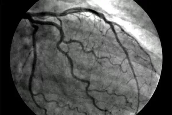 冠脉|【科普知识】心脏冠状动脉造影你知多少？