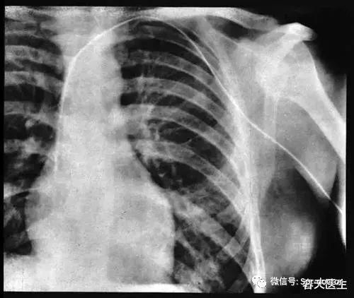 福斯曼|医学故事：拿自己做实验发明心导管 他拿诺奖却惹恼医界