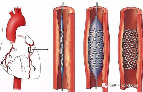福斯曼|医学故事：拿自己做实验发明心导管 他拿诺奖却惹恼医界