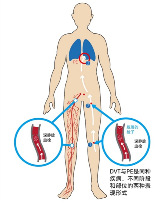 血栓|警惕“隐匿的杀手”，老年人如何预防血栓？