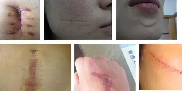 瘢痕和疤痕的区别 腾讯网