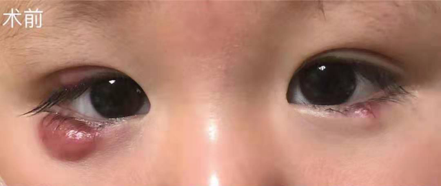 宝宝眼皮鼓包春节期间正确护眼姿势爸妈再忙也要看一眼