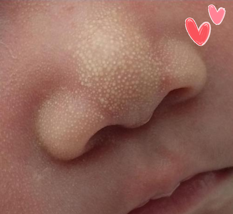 刚出生的宝宝,身上会出现一些小白点,比如说鼻子附近或者是眼皮附近