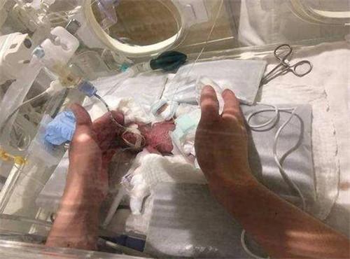 真实版拇指姑娘出生仅24厘米重280克15年过去现状如何