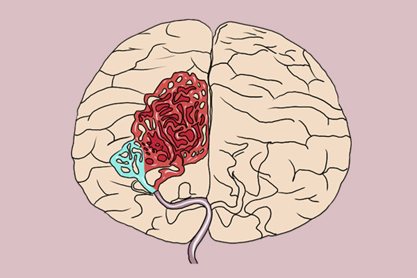 脑溢血|脑溢血发作之前，会给你机会，早点察觉到异常，能早就医