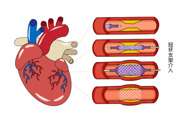 血管|放置支架15年，血管没堵过，身体也健朗，老英雄是如何保养的？