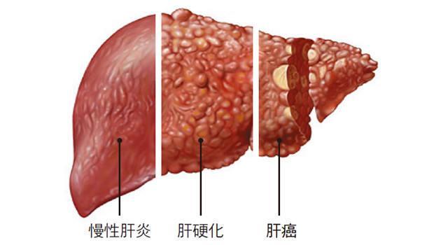 肝纤维化皮肤图片图片