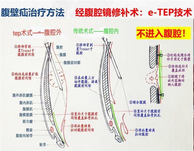 腹腔镜疝气修补术图解图片