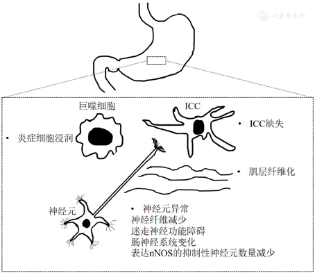 胃輕癱具有多種細胞的病理學改變,包括間質卡哈爾細胞(interstitial