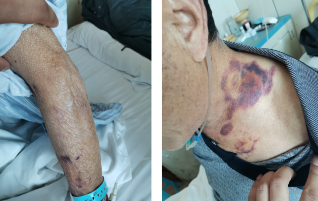 神志清楚,慢性病容,双上肢及颈部前胸皮肤可见大片紫癜(见图1),桶状胸