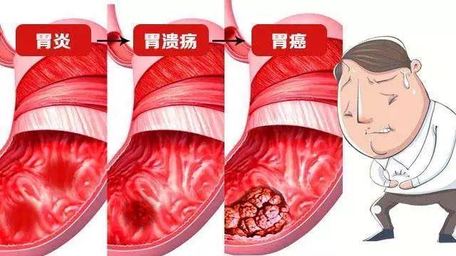 损伤胃黏膜的5大罪魁祸首,你占了几条,给您支招如何修复胃黏膜