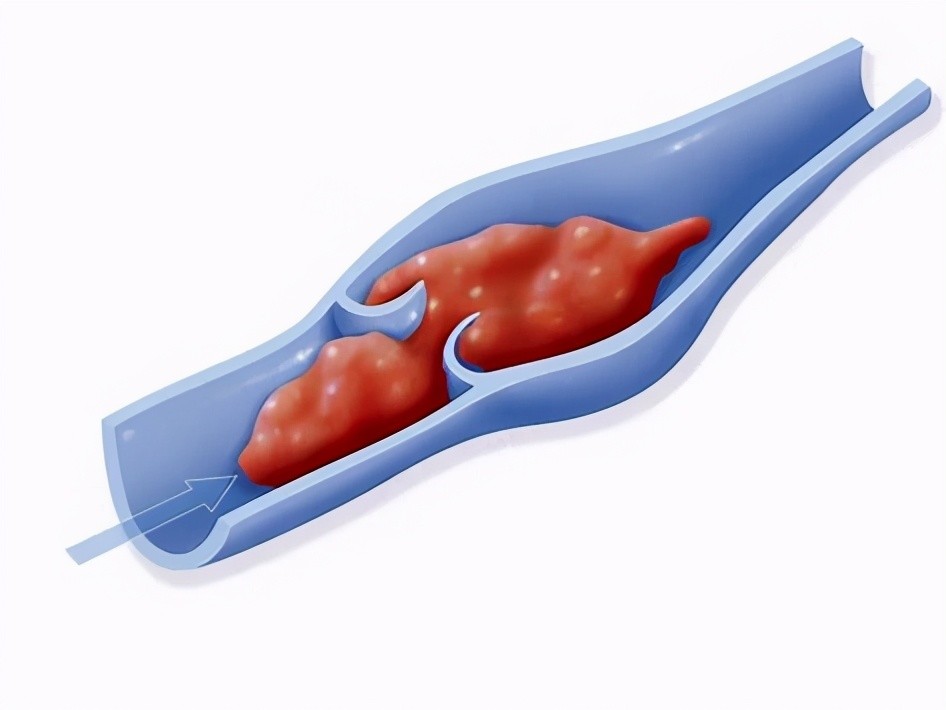 静脉血栓形成|动脉血栓和静脉血栓没有区别，治疗上都一样！医生辟谣讲清楚差别