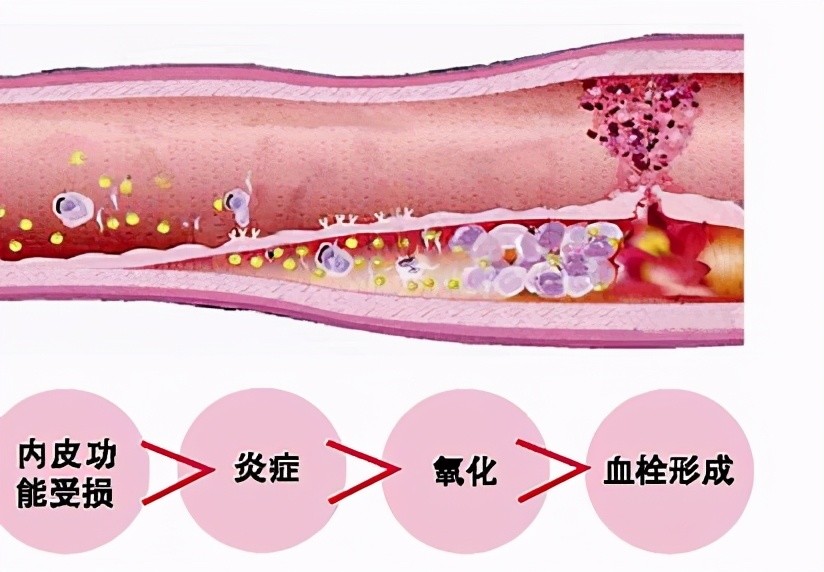 静脉血栓形成|动脉血栓和静脉血栓没有区别，治疗上都一样！医生辟谣讲清楚差别