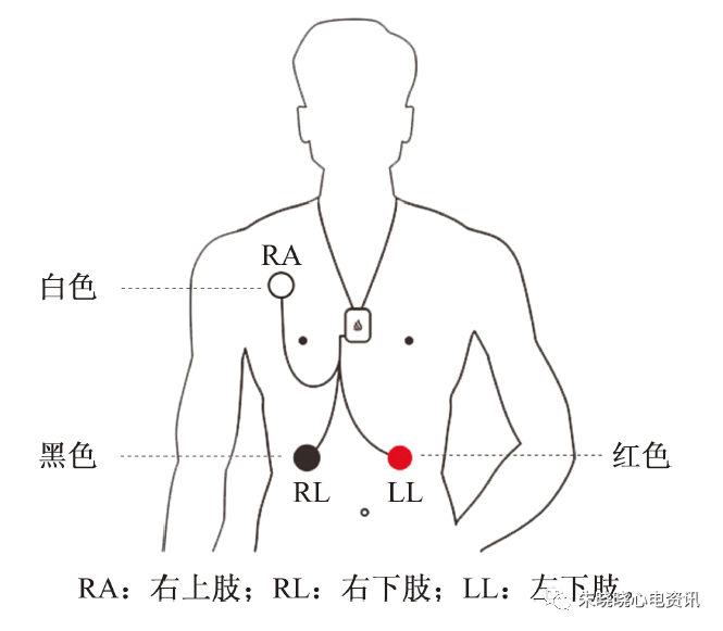 单导联可穿戴远程心电监测设备在有症状心律失常患者中的应用模式探讨