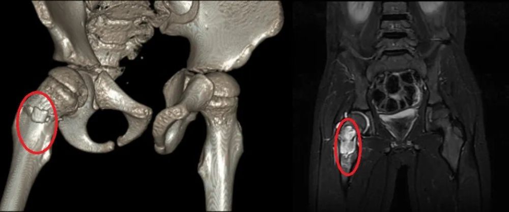 广东10岁男孩突然瘸了这个会隐身的肿瘤专害小孩子