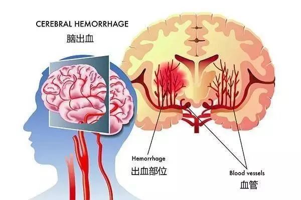 脑出血|健康科普｜脑出血高发季，只有认识它，才能预防它！