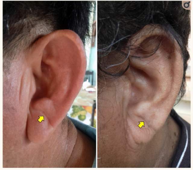 这篇文章的作者叫frank,所以这个折痕在医学上被称为:franks 征.