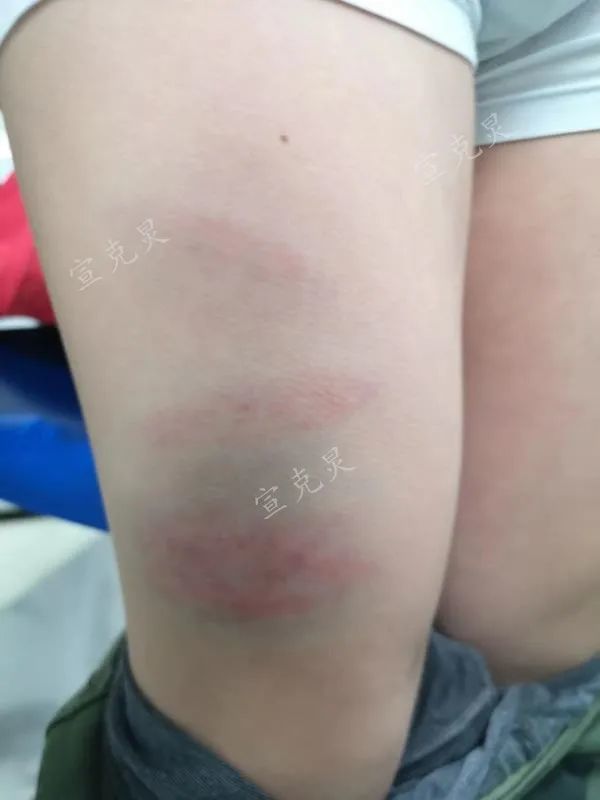 6岁男孩学羽毛球一身伤真相触目惊心